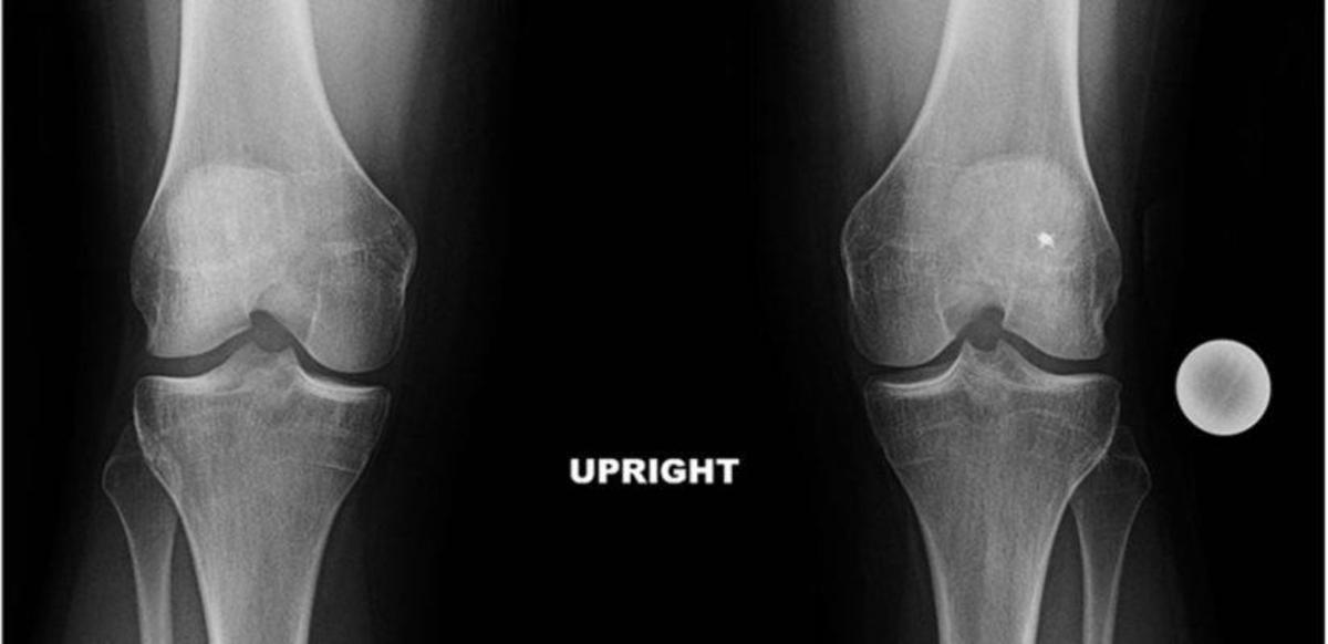 Întărirea mușchilor cu artroza genunchiului - Рубрика: Modul de calmare a durerilor articulare